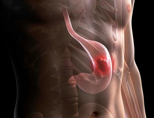 Korea, US, Japan surgeons back stomach-preserving gastric cancer surgery