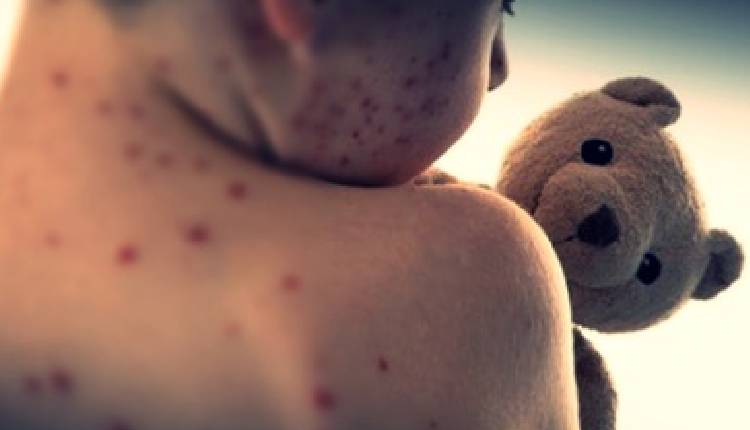 Measles Alert Issued For Sydney As Cases Rise In New South Wales