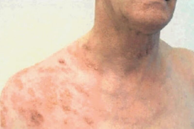 Western Cape records a rise in meningococcal cases among youth, as infants remain most at risk