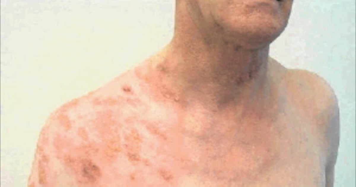 Western Cape records a rise in meningococcal cases among youth, as infants remain most at risk