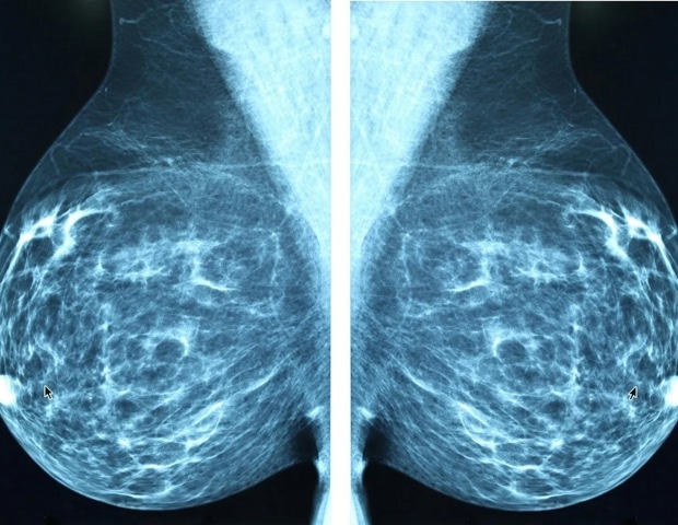 Study links high-fat diet to faster breast cancer progression